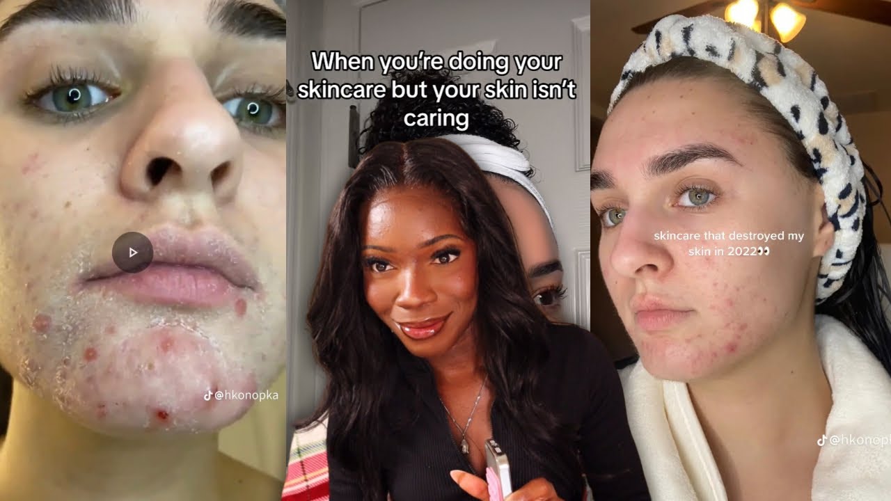tiktok trends r DAMAGING your sensitive skin 💔