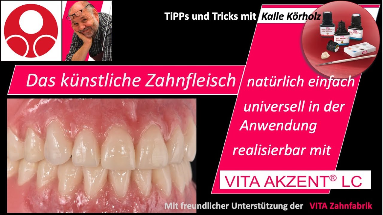 Das künstliche Zahnfleisch individualisieren mit VITA Akzent LC