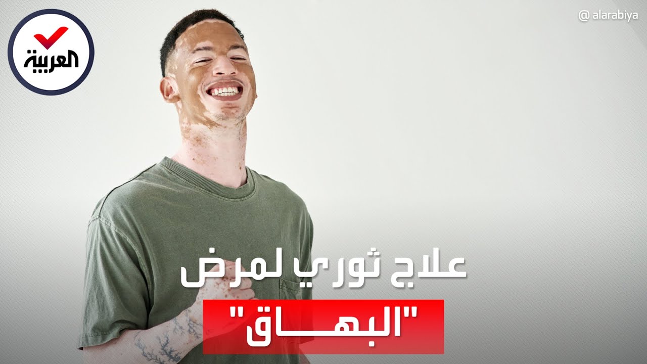 بشرى سارة لمرضى البهاق.. دواء منزلي يعيد الجلد لطبيعته