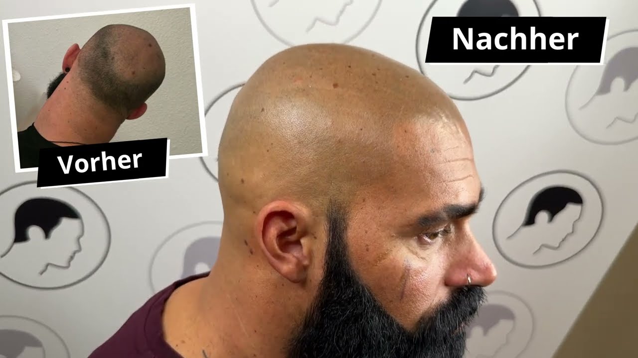 Haarpigmentierung von Marco Bender bei Modern Hair Loss Solution