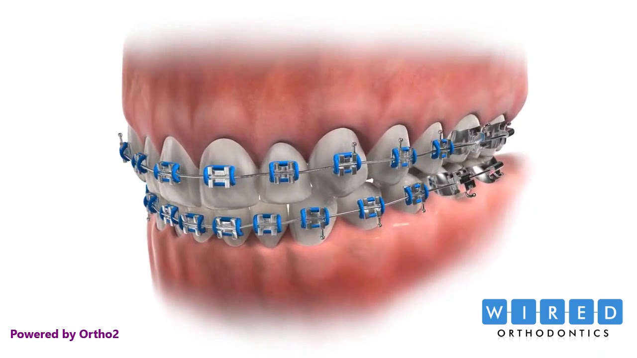 Foods To Avoid with Braces in Toronto