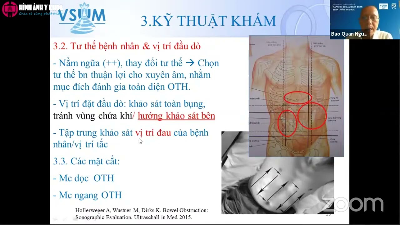 [CME] Siêu âm chẩn đoán tắc ruột non (2021) BS Nguyễn Phước Bảo Quân