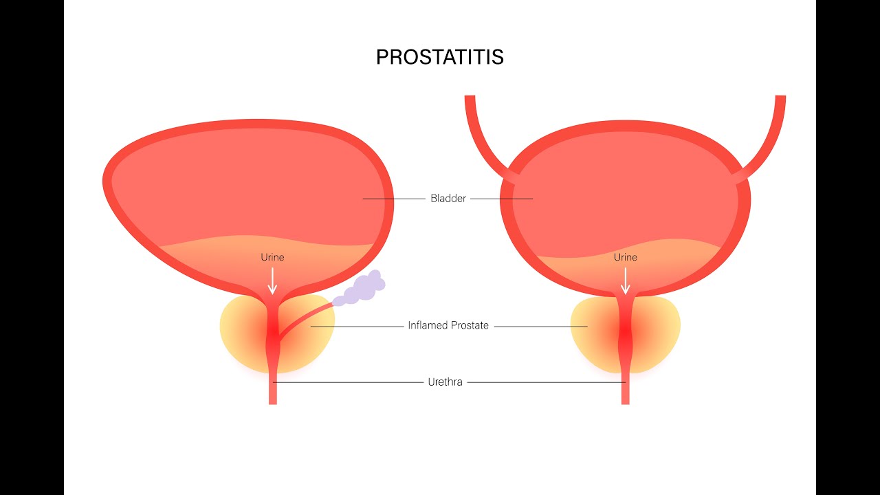 Prostatite batterica cronica e prostatite batterica acuta; cause, sintomi, diagnosi, trattamento