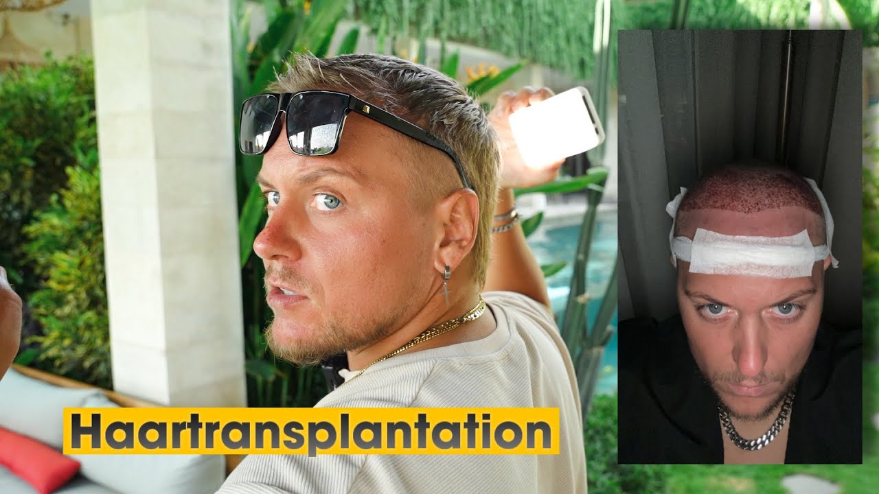 Haarausfall nach Haartransplantation ? Mein Haarstatus 3,5 Monate nach der OP.