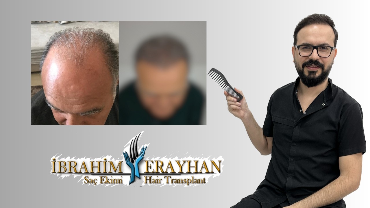 Seyrek ve İnce Telli Saç 2 Seanslık Değişimi | 2 Session Transformation for Thinning and Weak Hair.