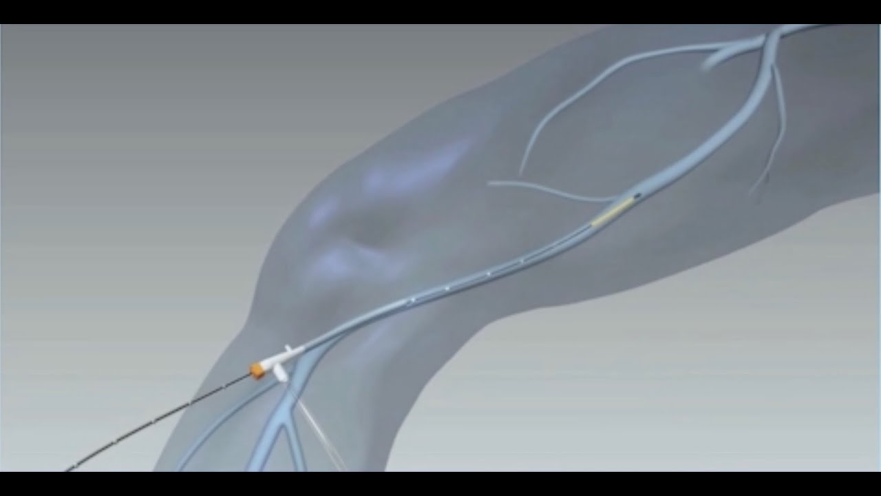 ClosureFast Procedure (Radiofrequency Ablation)