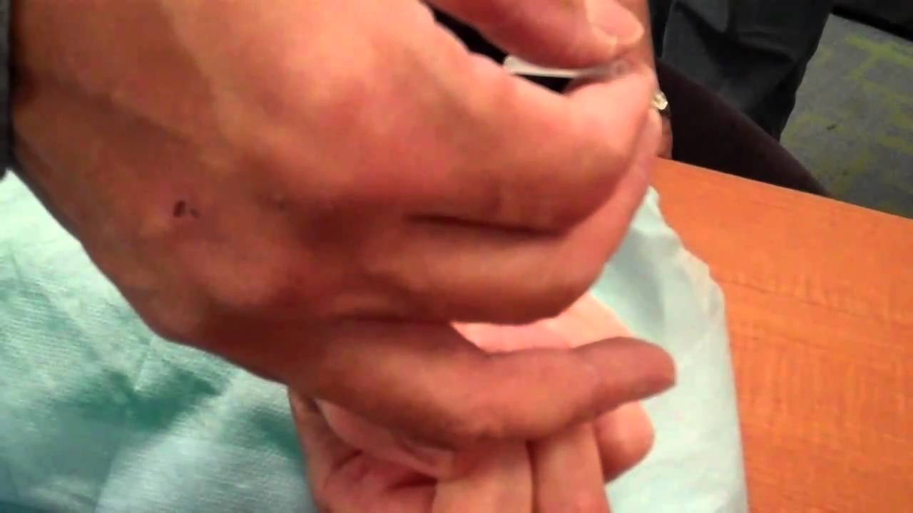 McMaster Medical Acupuncture Program: Acupuncture Point PE 6