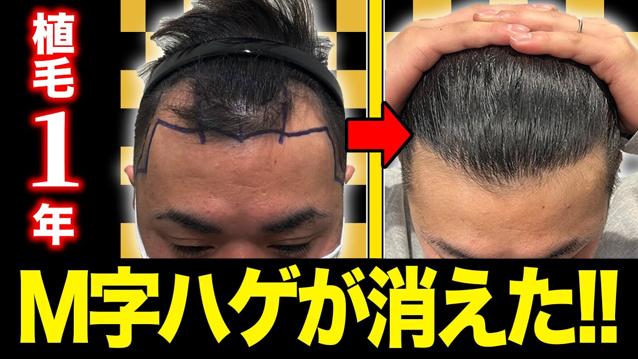 【祝1年経過】自毛植毛で人生変わるくらい変化しました！【M字ハゲ】