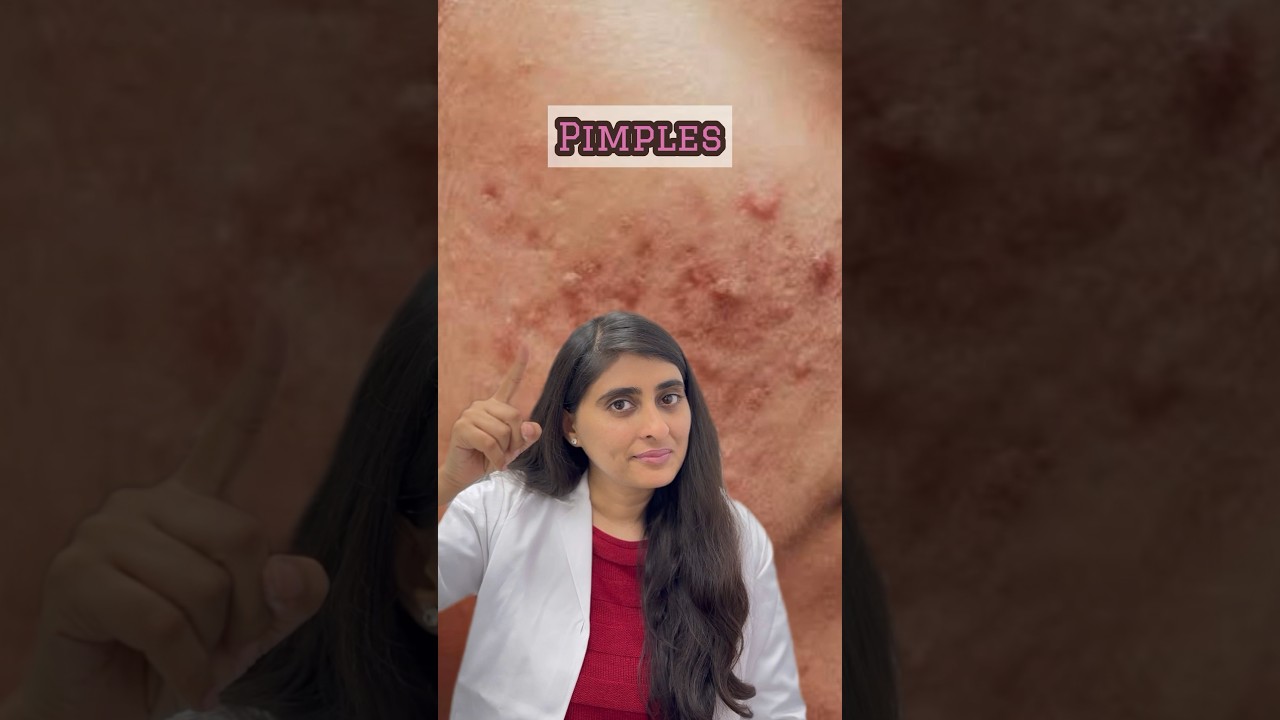 How to use Azelaic Acid | Skincare for hyperpigmentation |Skincare for pimples and dark spots