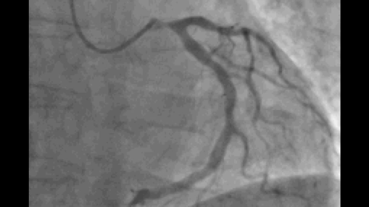 Left Main NSTEMI