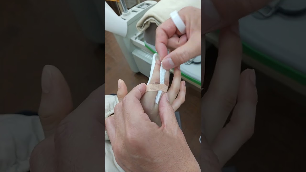 指関節固定　骨折疑い　finger fracture?