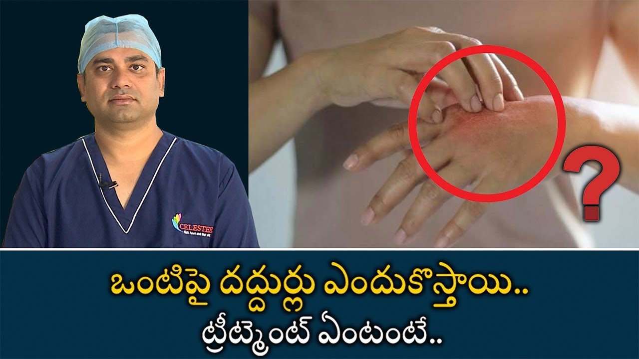 Urticaria Causes Treatment and Symptoms | ఒంటిపై దద్దుర్లు ఎందుకొస్తాయి.. ట్రీట్మెంట్ ఏంటంటే..
