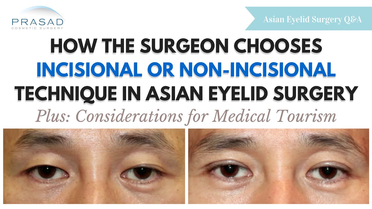 Extra Fat and Skin Determine Type of Asian Eyelid Surgery - Considerations for Medical Tourism