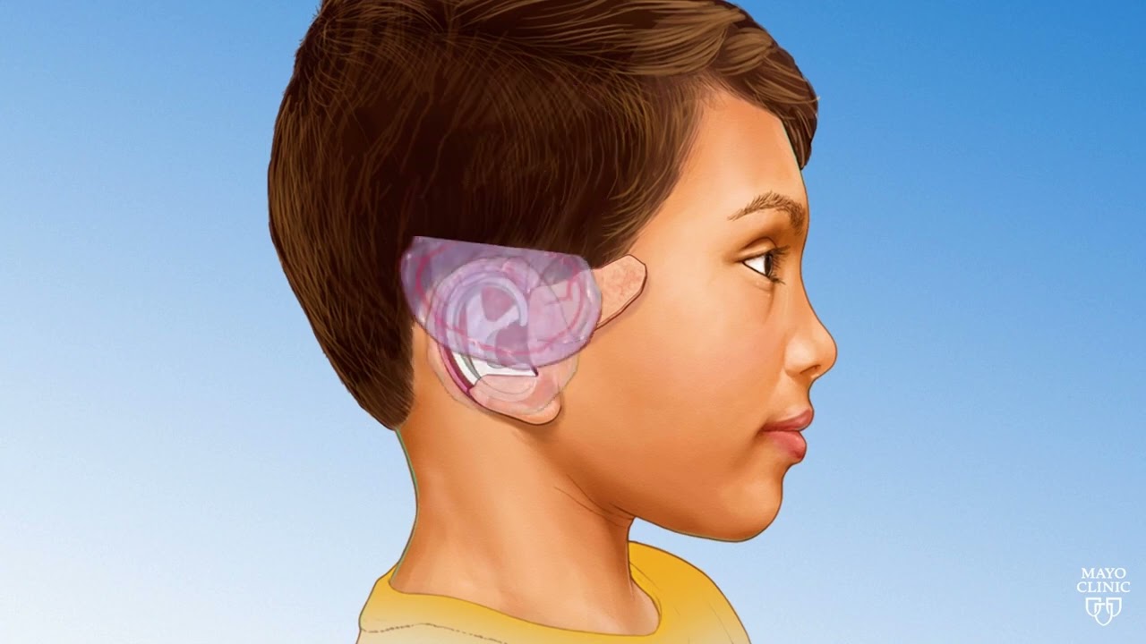 Innovations in Pediatric Ear Reconstruction