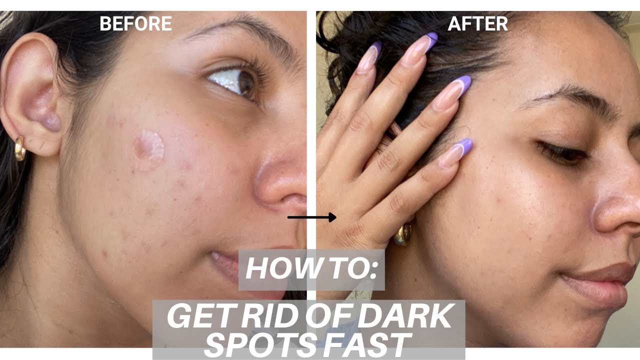 Help Visibly Reduce Dark Spots and Hyperpigmentation Ft. Hyper Skin | Sephora