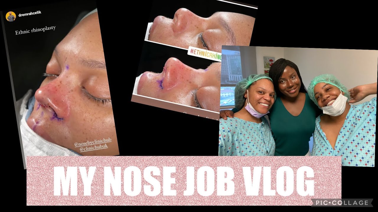 ETHNIC RHINOPLASTY/NOSE JOB VLOG!!