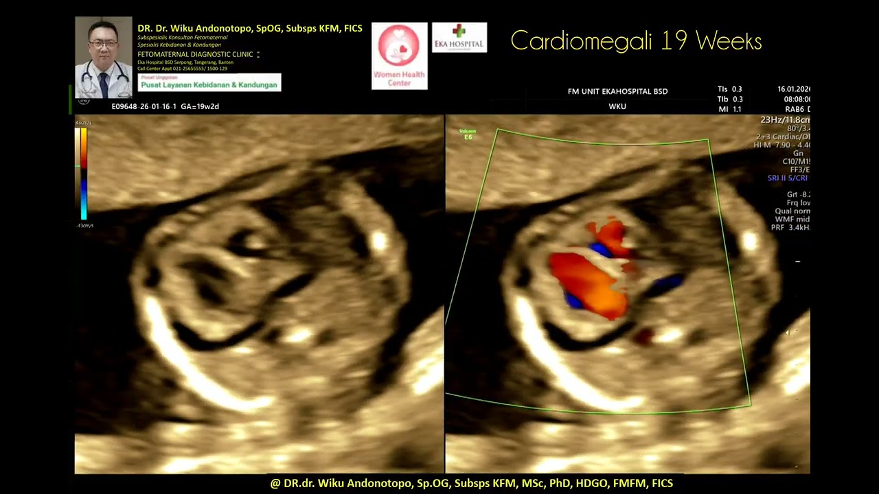Cardiomegaly 19 weeks