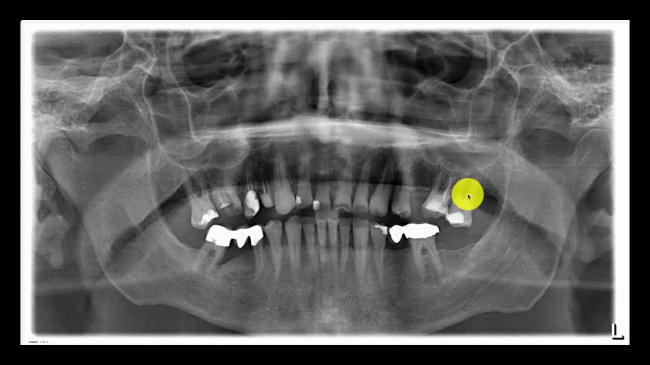 Zahnsanierung von Denta Beauté