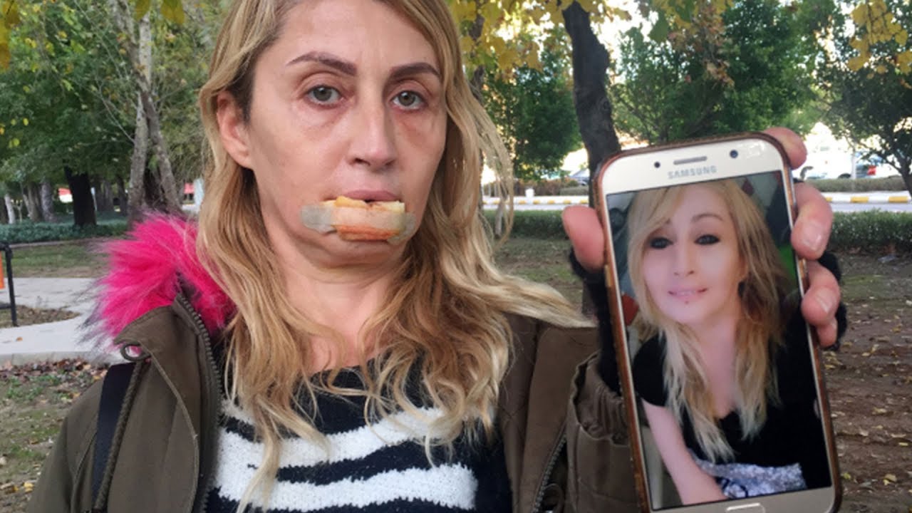 Güzellik uğruna kaybettiği dudağına yeniden kavuşacak