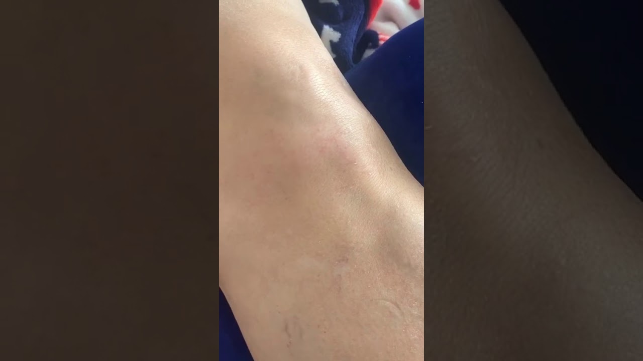Dr. NICOLA IMBRIANI Trattamento Laser Mectronic Theal per Condropatia Femoro-rotulea di 2 grado