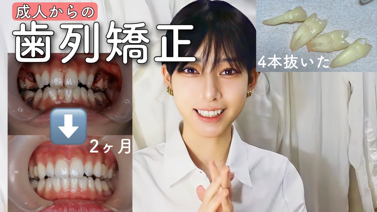 【歯列矯正】費用は？変化は？理由は？決め手etc...【20歳から始めました】