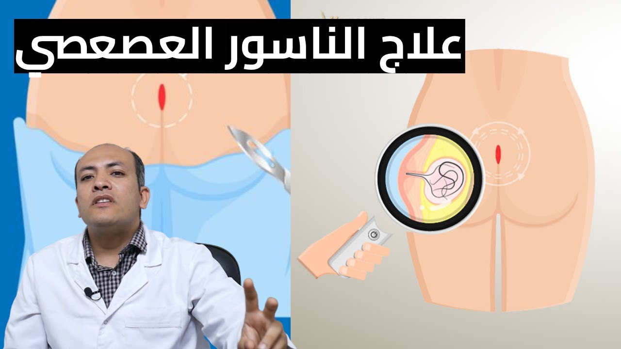 علاج الناسور العصعصي