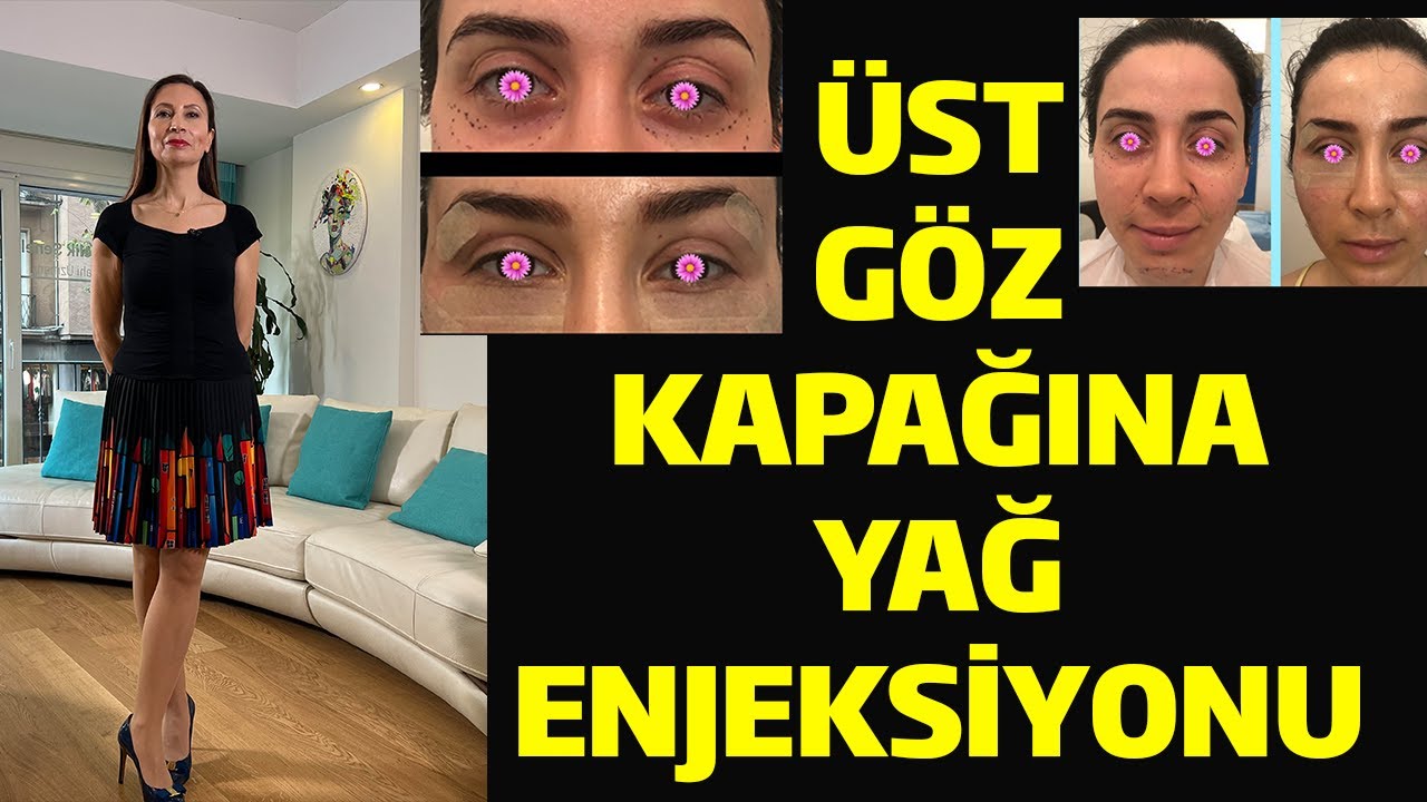 Üst Göz Kapağına Yağ Enjeksiyonu