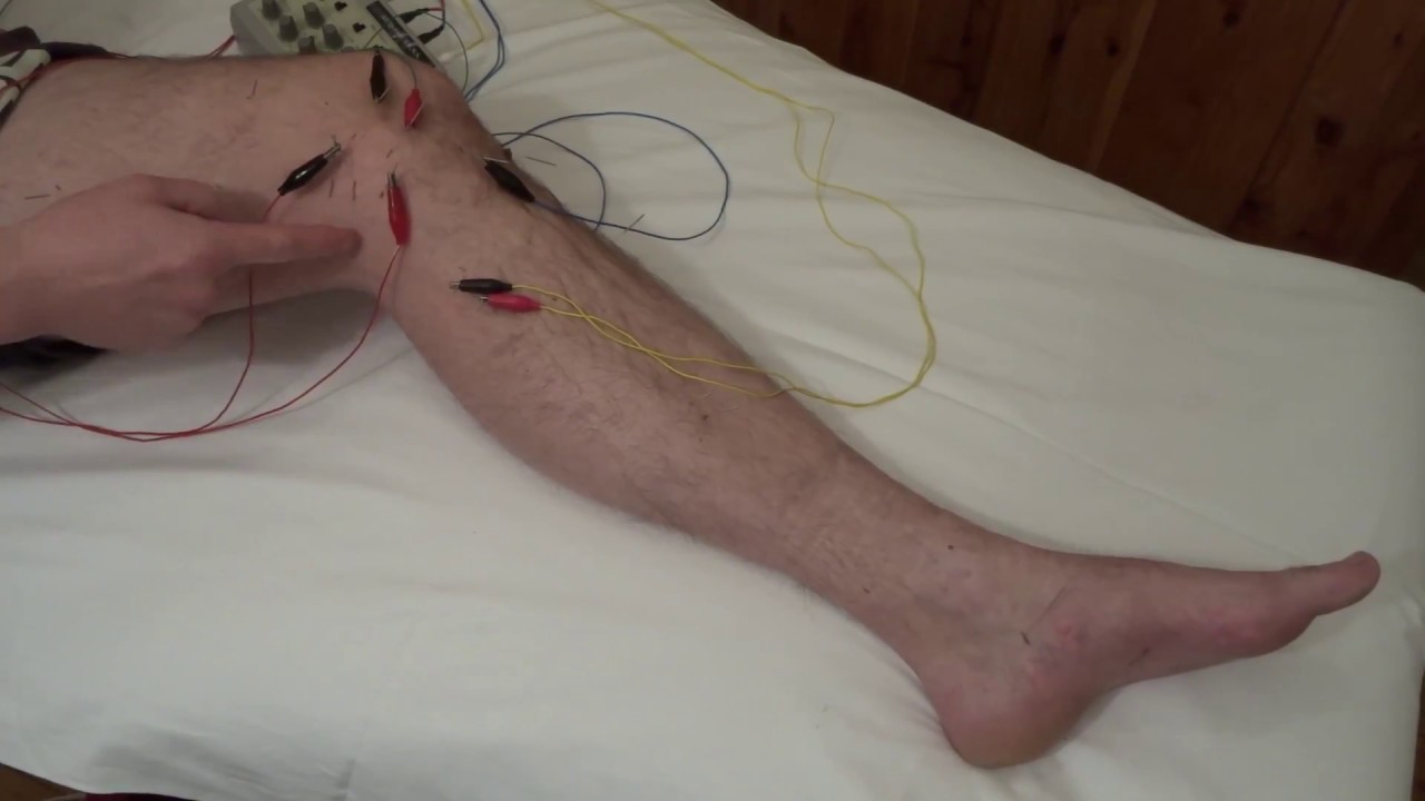 acupuncture treatment explained medial knee meniscus