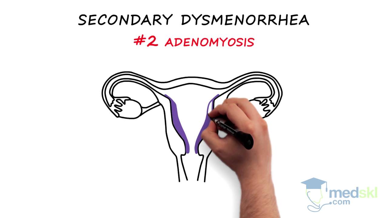 Obstetrics and Gynecology – Dysmenorrhea: By Paul Davies M.D.