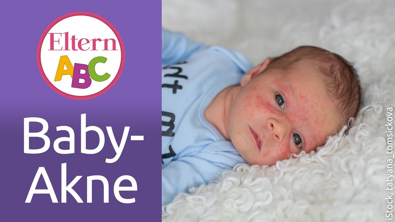 Baby-Akne: Was kann ich tun, wenn mein Kind Baby-Akne hat? | Baby | Eltern ABC | ELTERN