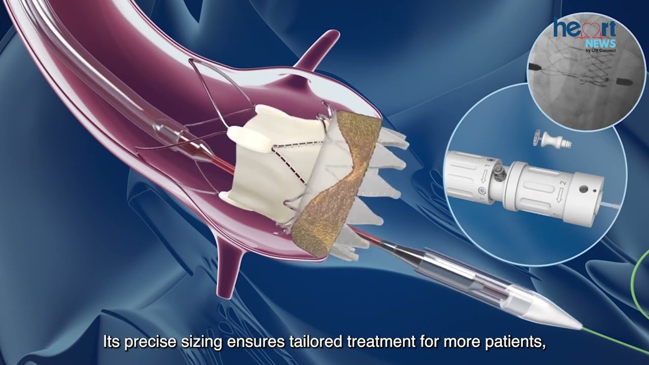 Heart News: IJN Introduces ACURATE neo2 for Aortic Stenosis Treatment