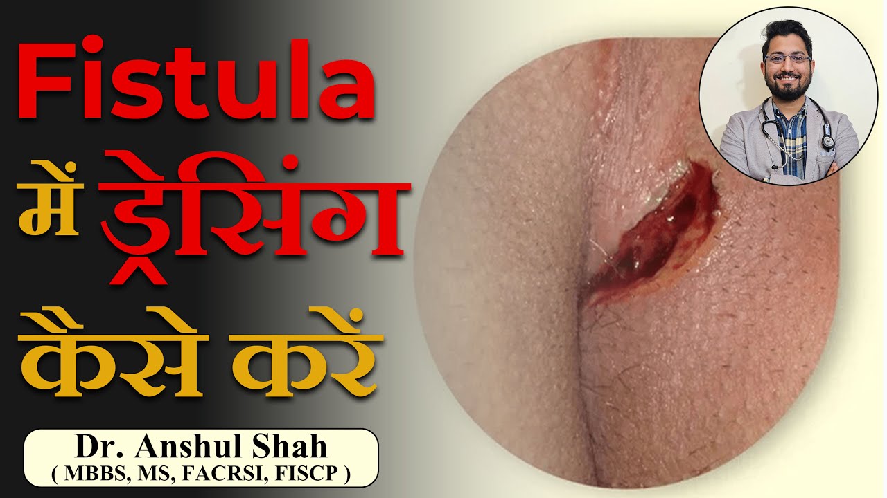 फिस्टूला में ड्रेसिंग ? महत्वपूर्ण तकनीकें और टिप्स |