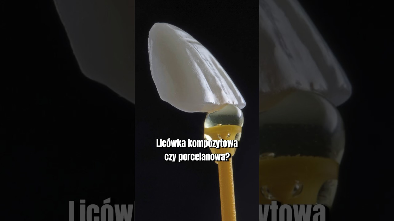 Lic&oacute;wka kompozytowa, czy porcelanowa? #lic&oacute;wki #veneers #lic&oacute;wkikompozytowe #lic&oacute;wkiporcelanowe