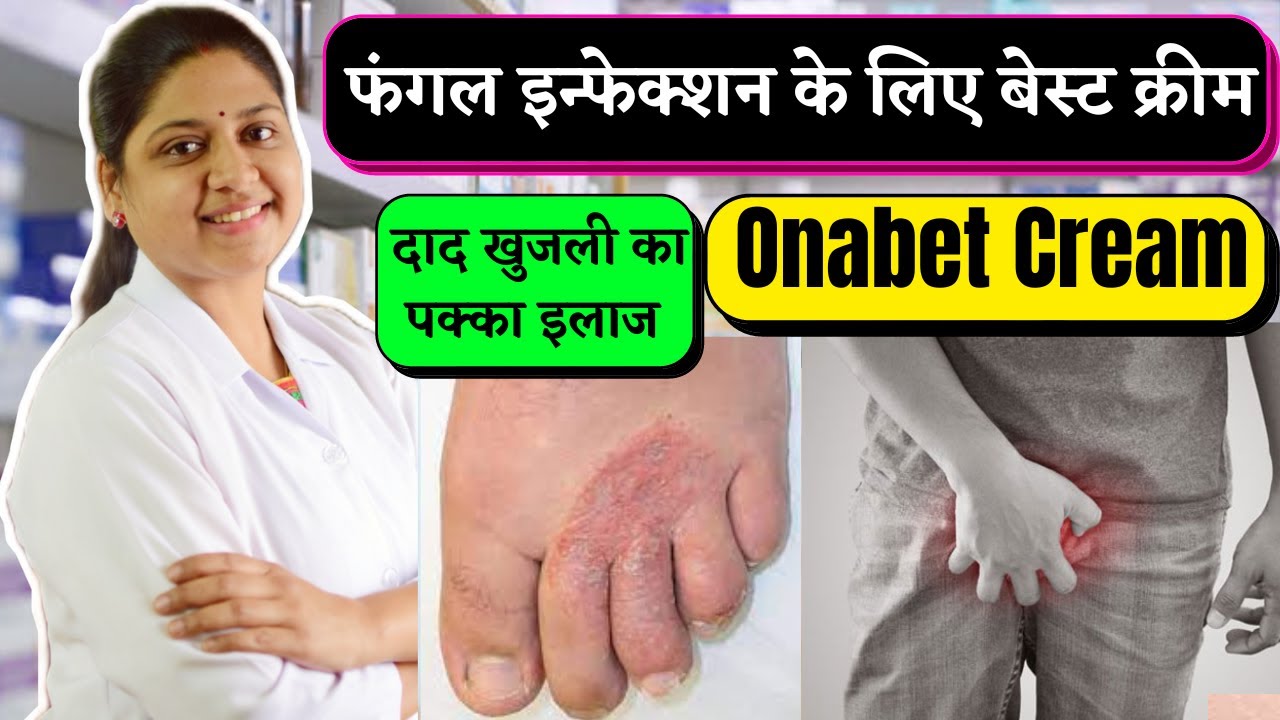 Onabet Cream - Sertaconazole Nitrate Cream 2 W/W - Antifungal Cream - Onabet Cream Kis Kaam Aati Hai