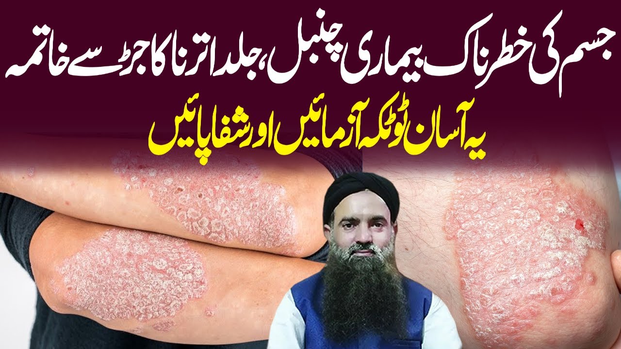 Jild ke khatarnak bemaari chambal Ka ilaj | Psoriasis Skin Disease - Chumbal Ka Ilaj Dr Sharafat Ali