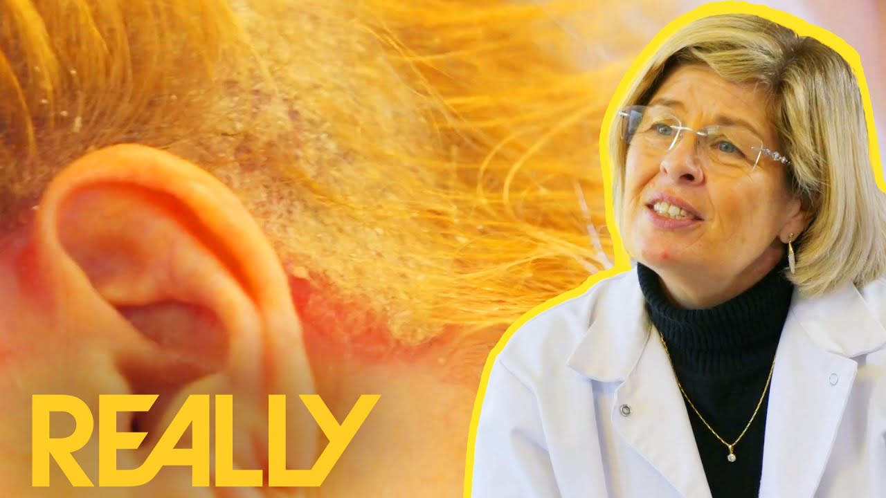 Woman Living With Psoriasis Gets Confidence Boost After Major Hair Makeover | The Hair Loss Clinic