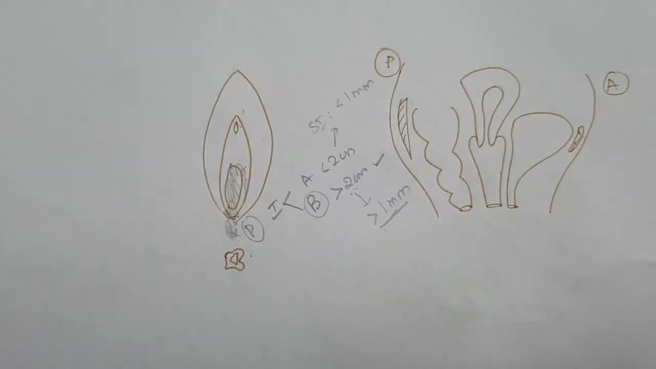 Vulvar Carcinoma FIGO Staging