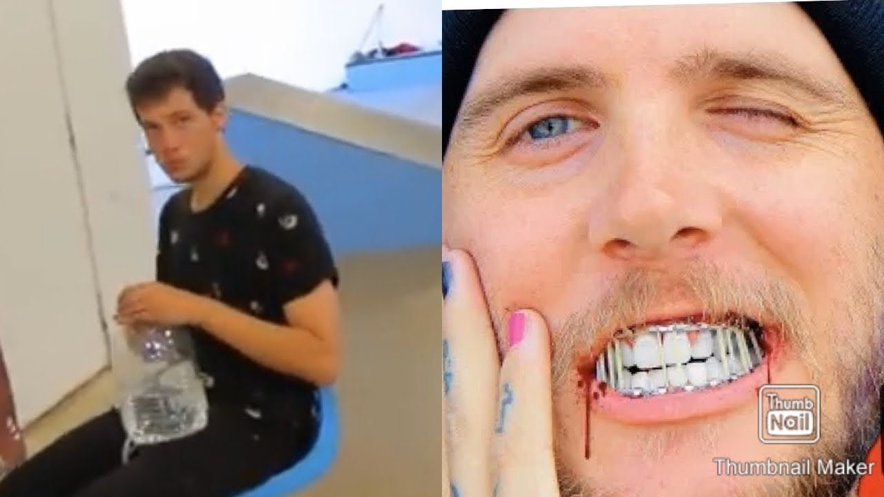 FETTY POTTER BROKEN JAW BEHIND THE SCENES (story time)