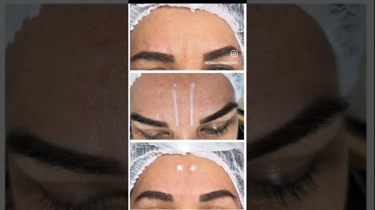 Tratamento para ruga profunda da glabela com fios filler.92 991358365/Manaus_Am.