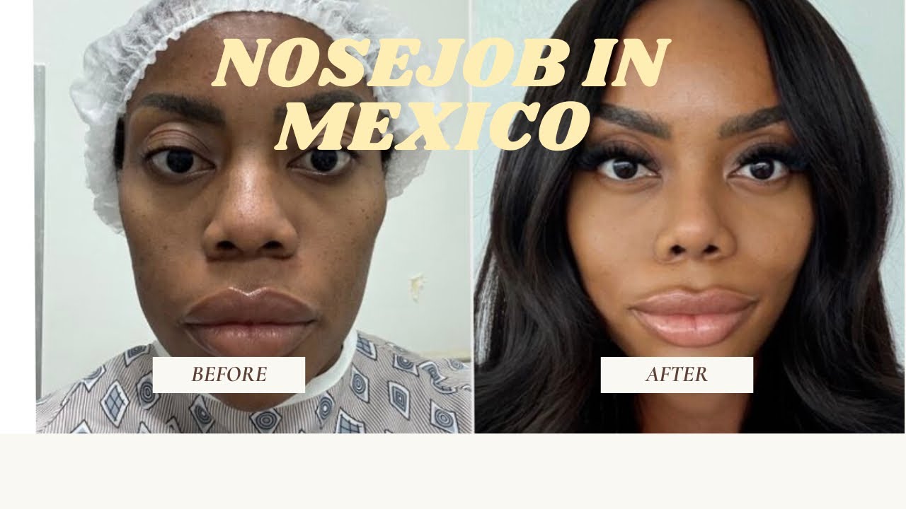 My Ethnic Rhinoplasty in Tijuana: The Real Tea ☕