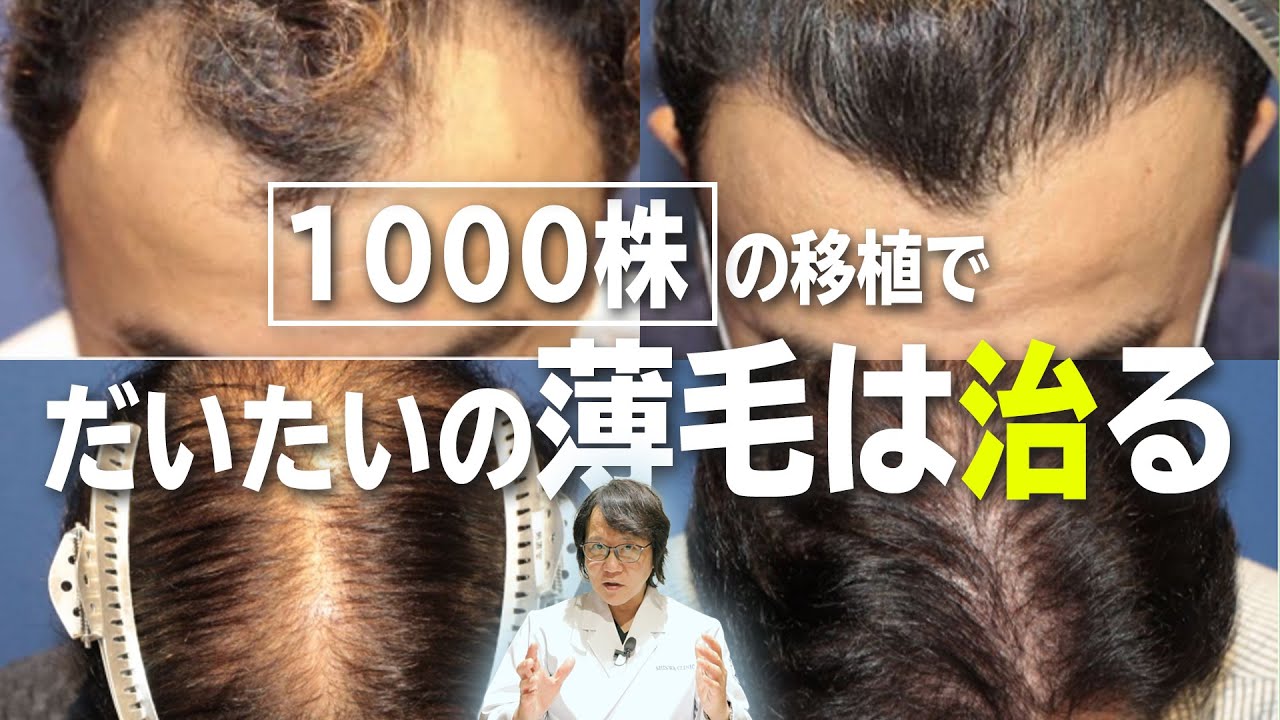 【自毛植毛】1000株の自毛植毛症例について、薄毛治療の専門医が解説いたします。