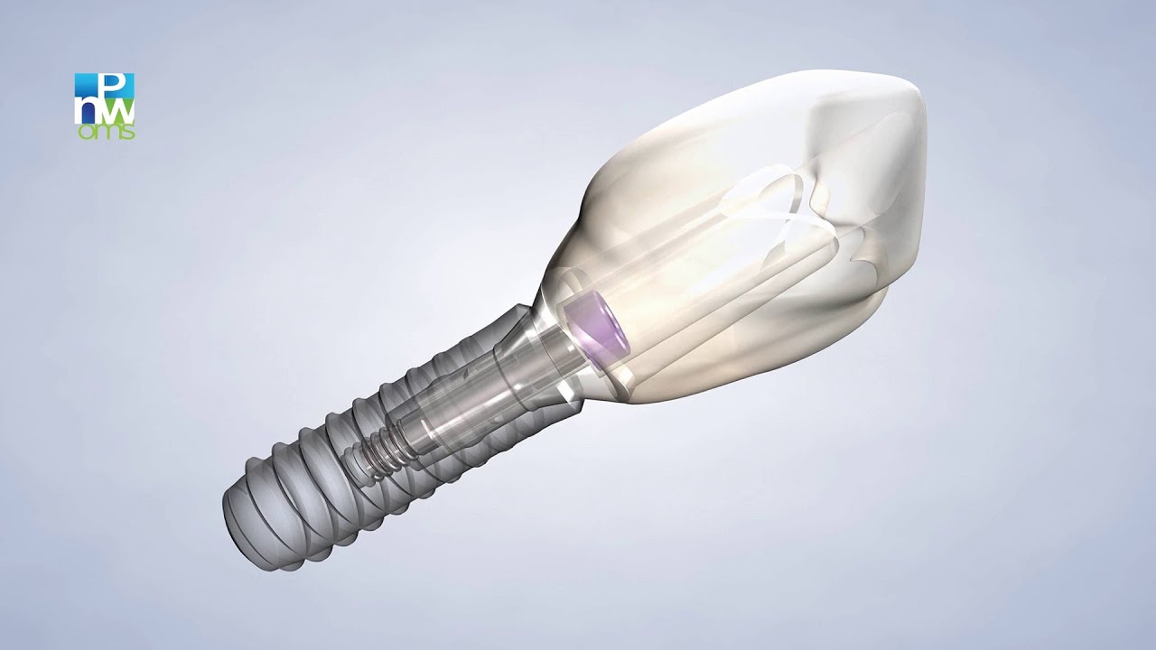 Post-Operative Instructions: Dental Implants | Pacific Northwest Oral & Maxillofacial Surgeons