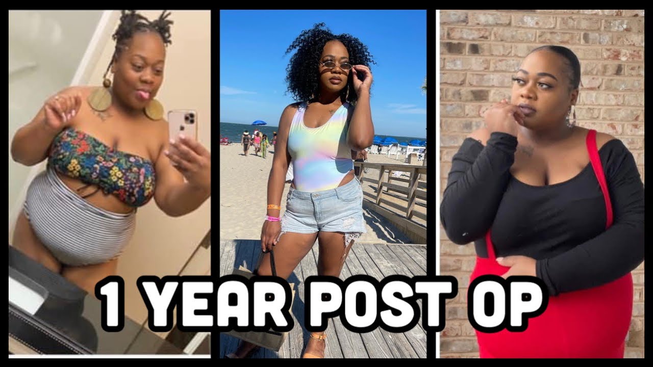 Gastric Bypass 1 Year Post Op | Update