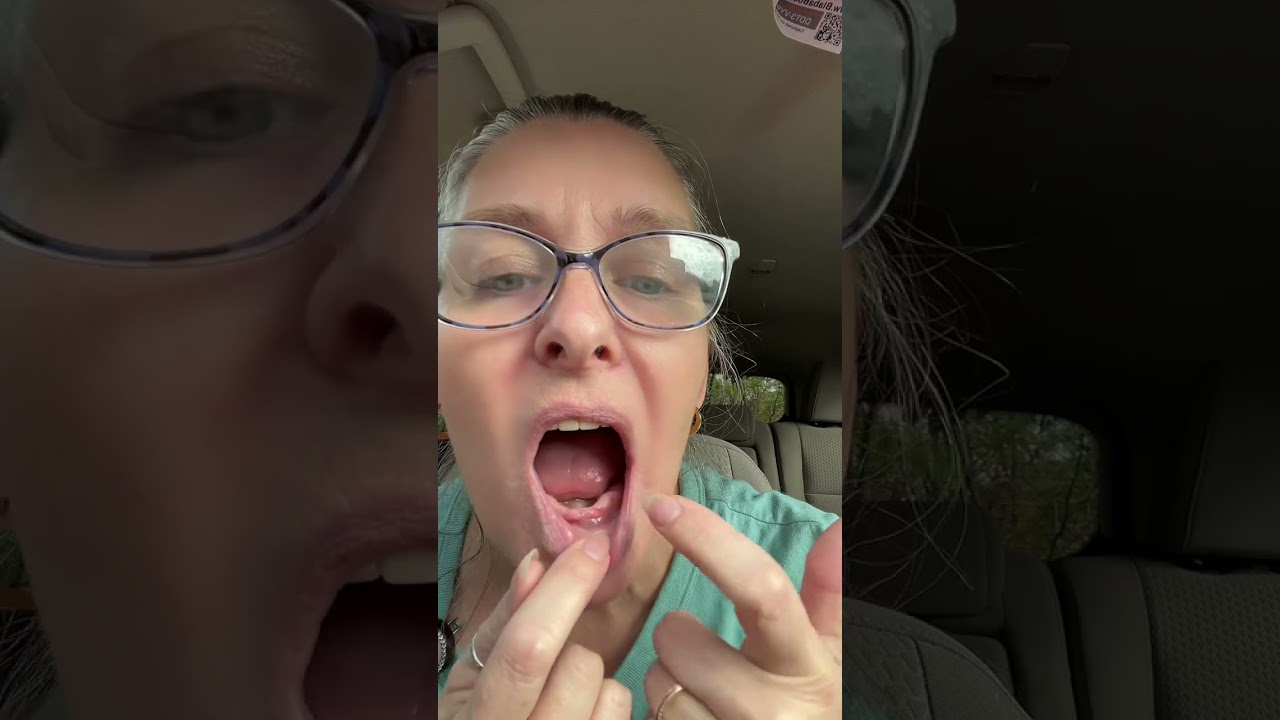 Day 89 of my denture journey 