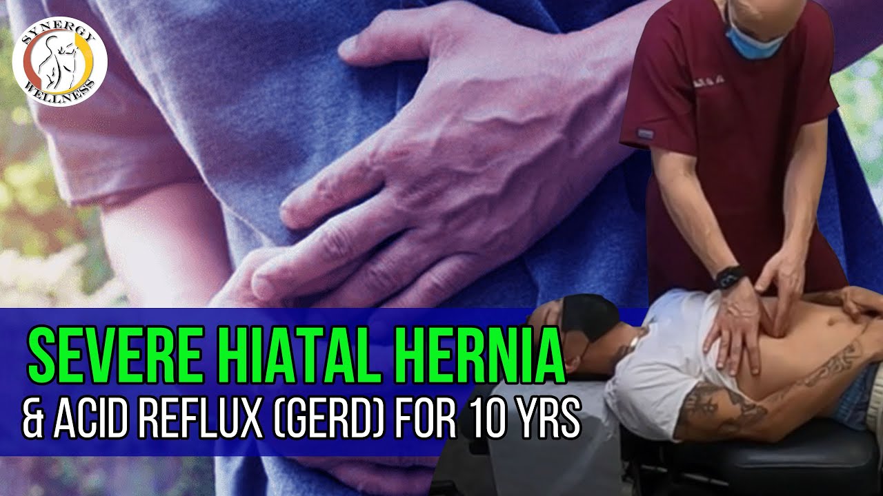 SEVERE HIATAL HERNIA & ACID REFLUX (GERD) for 10 Yrs - NON Surgical Hiatal Hernia Treatment