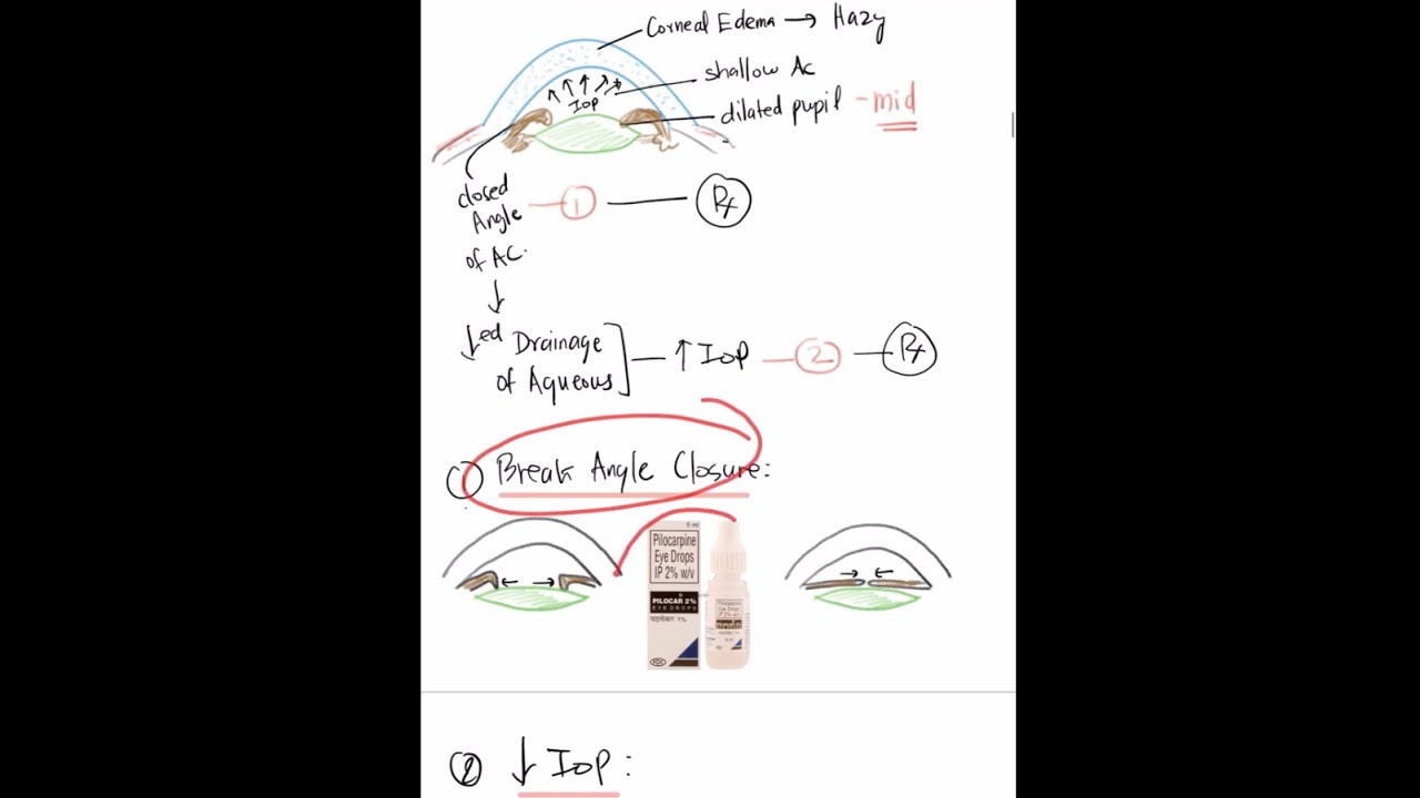 MCQ 2: Essentials in Acute Angle Closure Glaucoma  #Mustknow #UKMLA