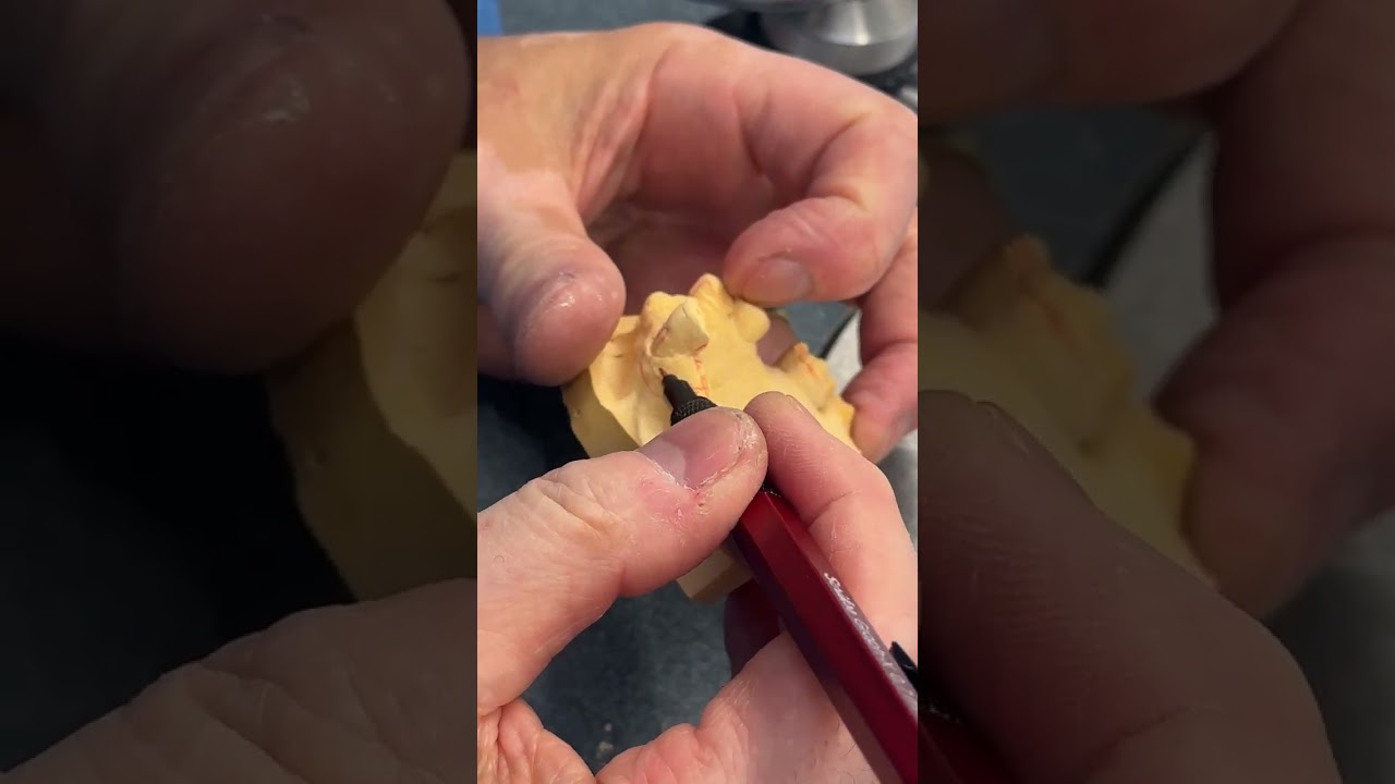 Dr. Eddie Sheh - Maxillary cast RPD design drawing (Western University CDM)