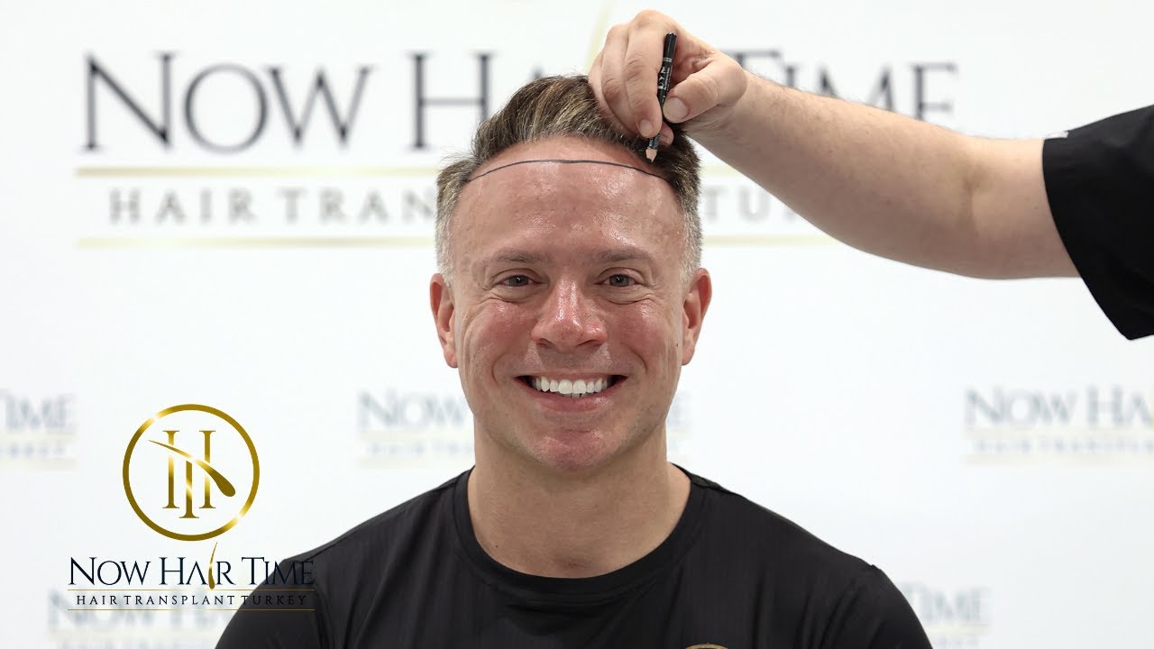 Not Just a Hair Transplant — It’s a Full Confidence Journey