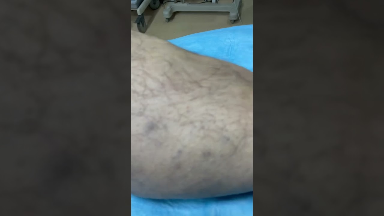 Bacak varislerinin y&ouml;netimi nasıl olmalı?