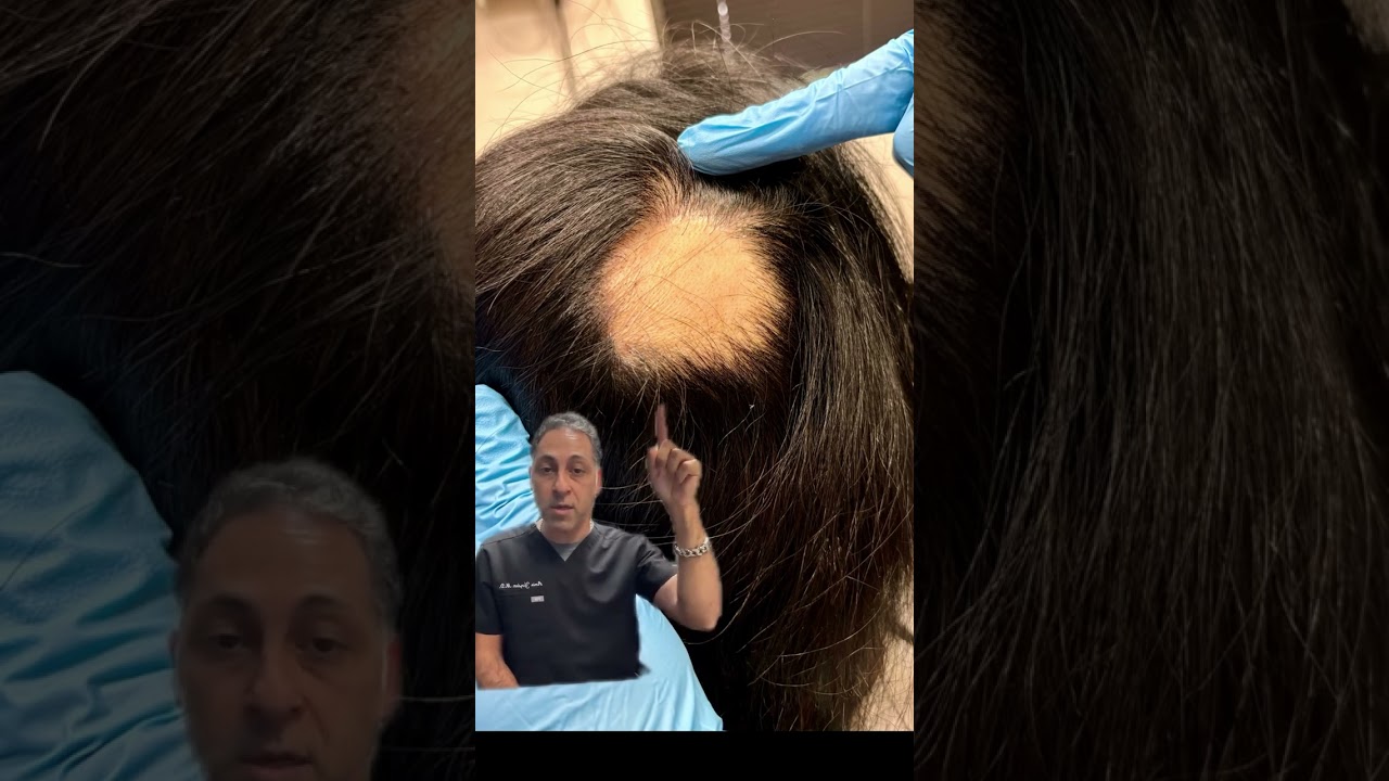 hairloss due to autoimmune condition